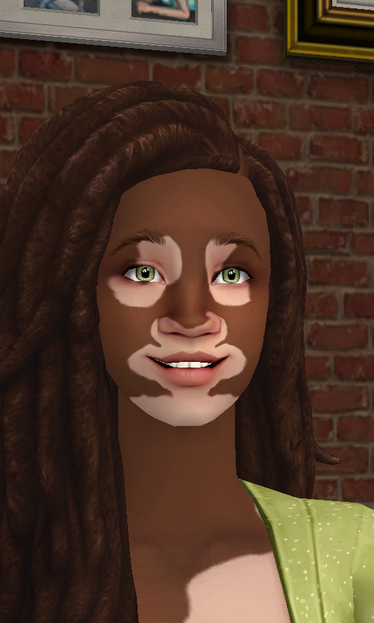 Vitiligo1