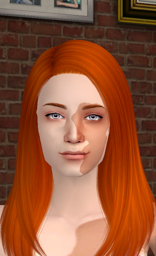 Vitiligo2